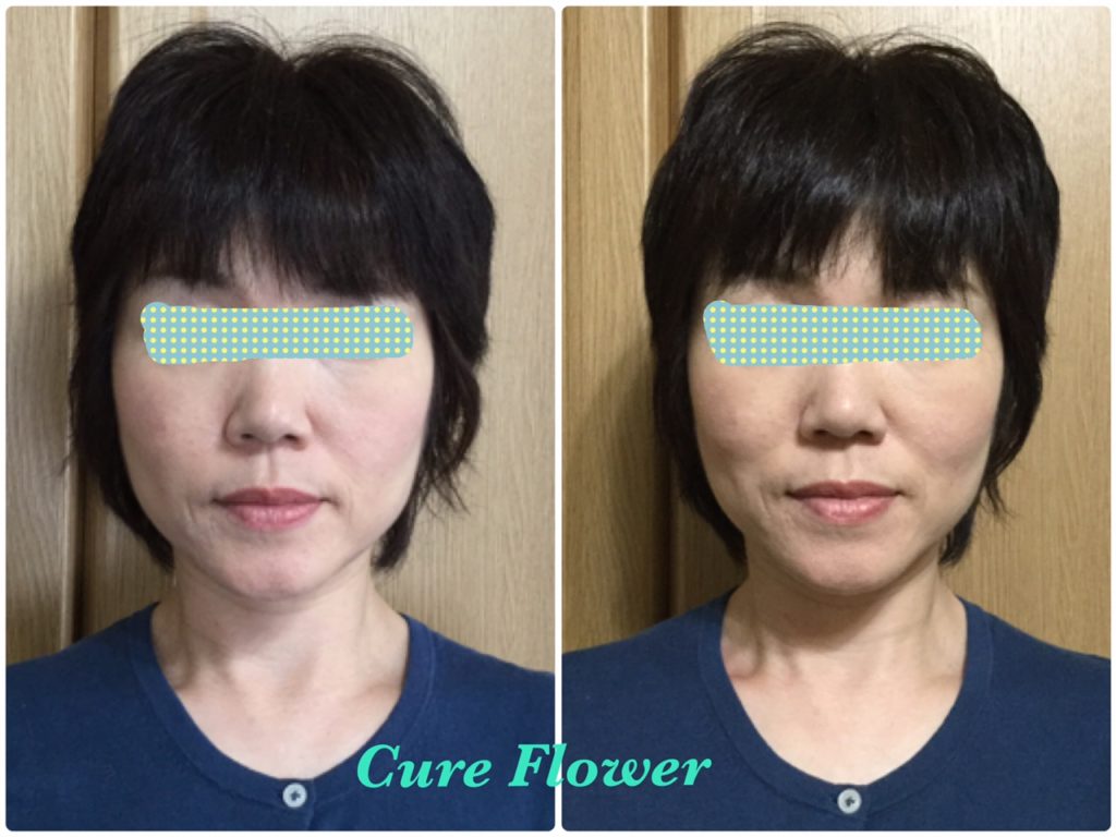 小顔矯正、small face correction