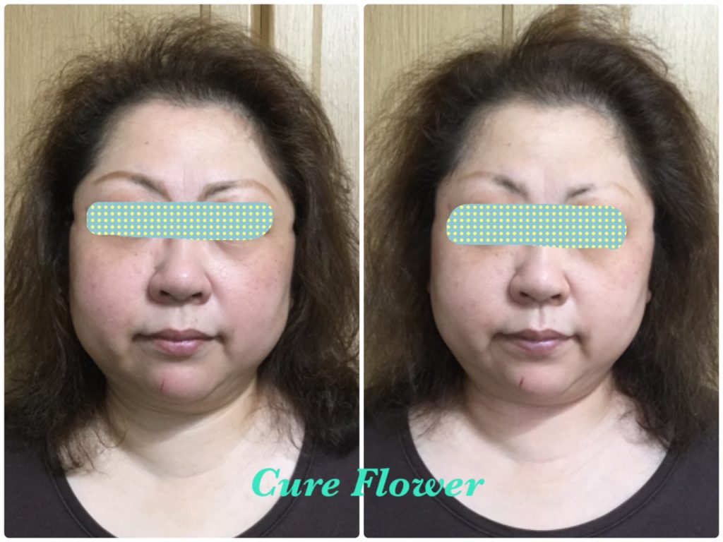 小顔矯正モニター、small face correction