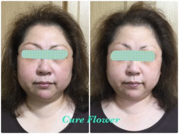 小顔矯正2回目