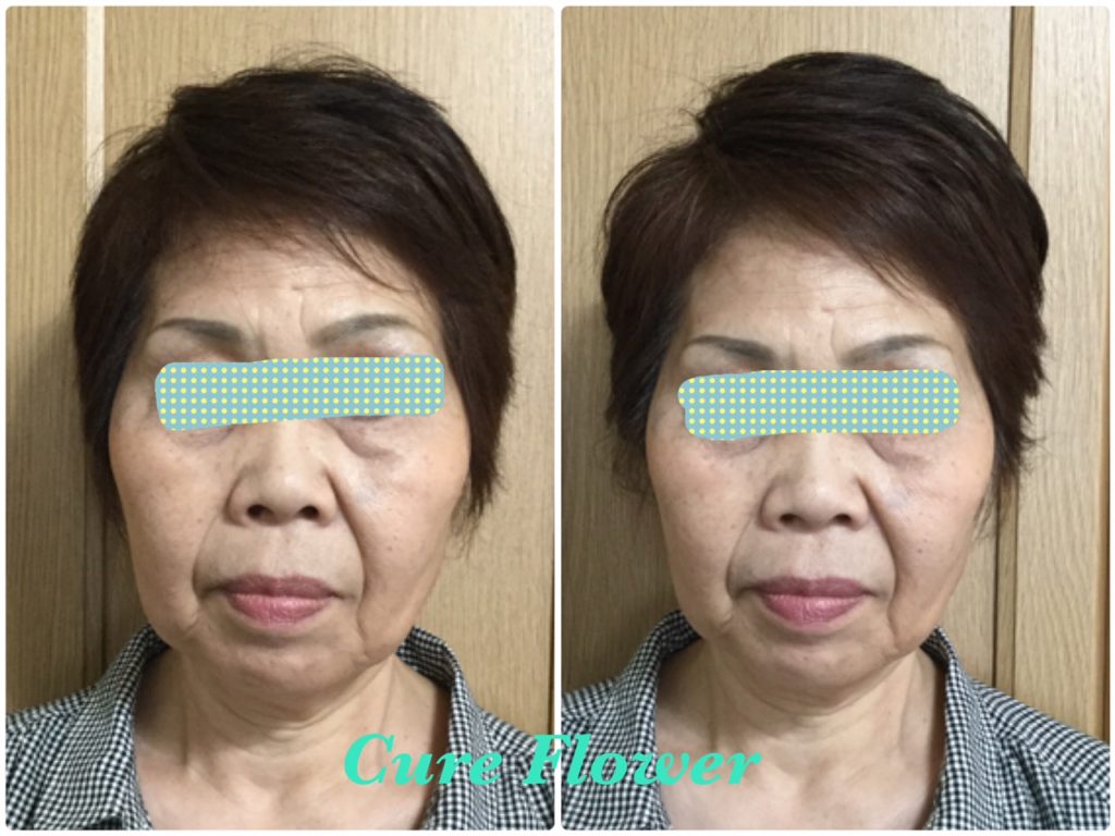 小顔矯正、small face correction