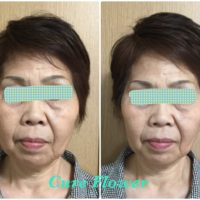 小顔矯正、small face correction