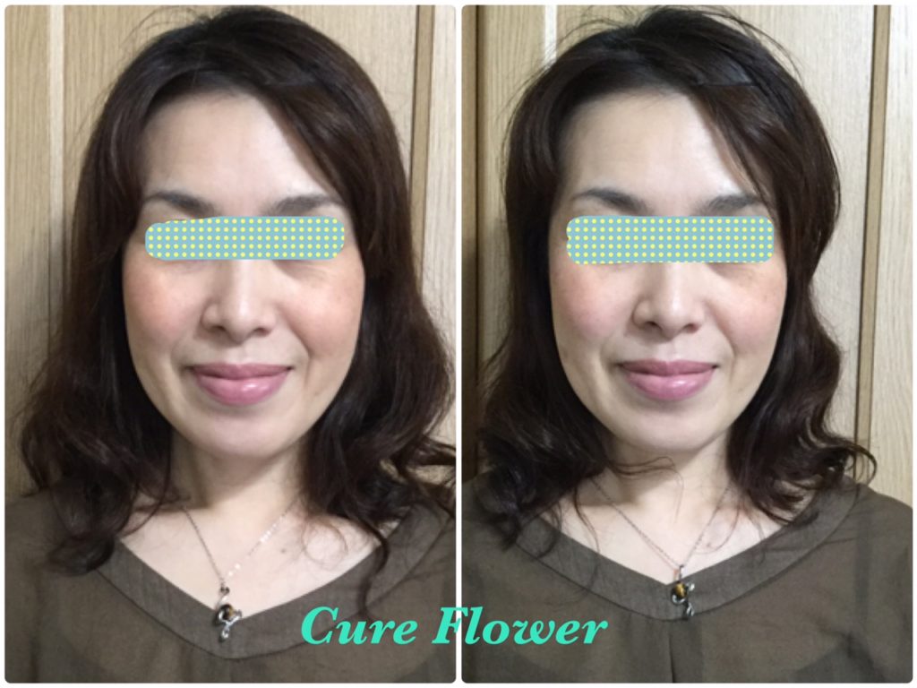 小顔矯正, small face correction