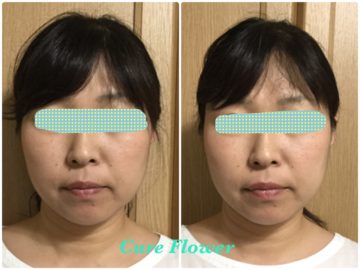 小顔矯正、small face correction