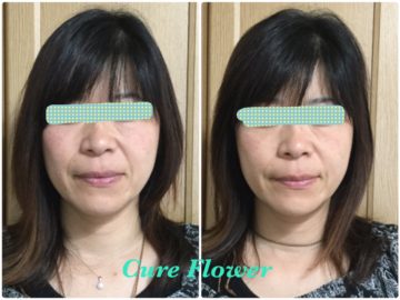 小顔矯正、small face correction