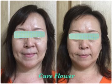 小顔矯正、small face correction