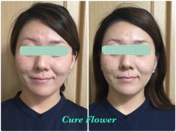 小顔矯正、small face correction