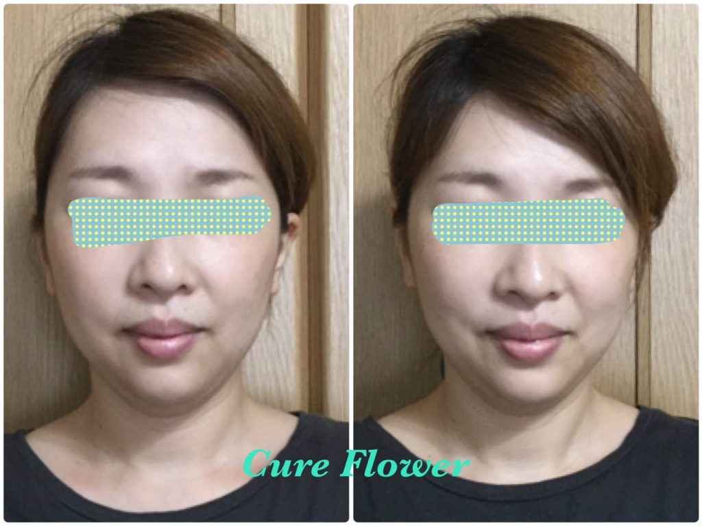 小顔矯正、small face correction