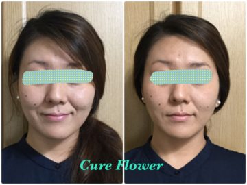 小顔矯正、small face reform