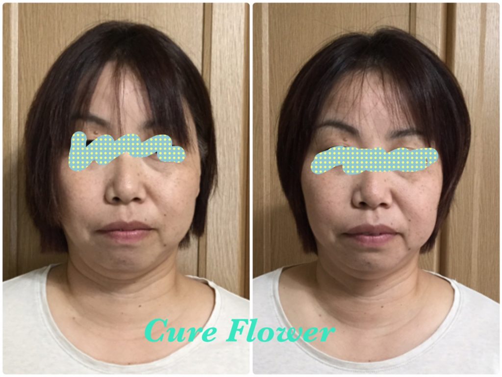 小顔矯正、 small face correction