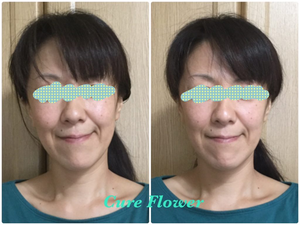 小顔矯正, small face correction