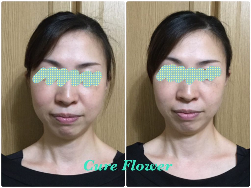 小顔矯正,　small face correction