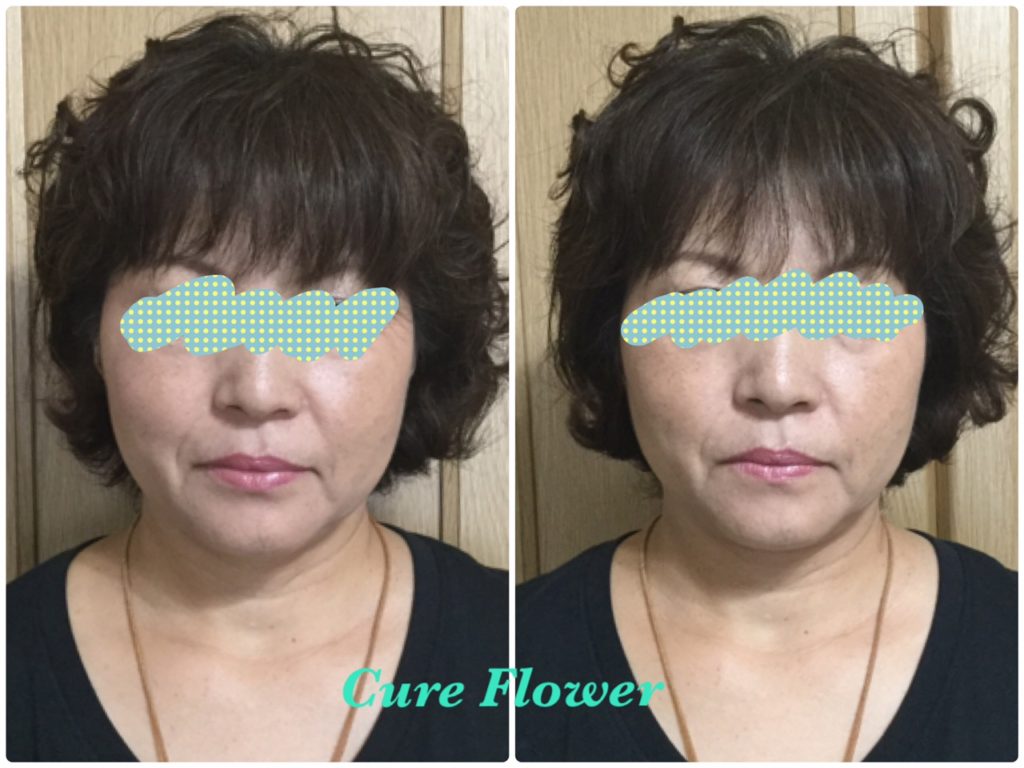 小顔矯正、small face correction