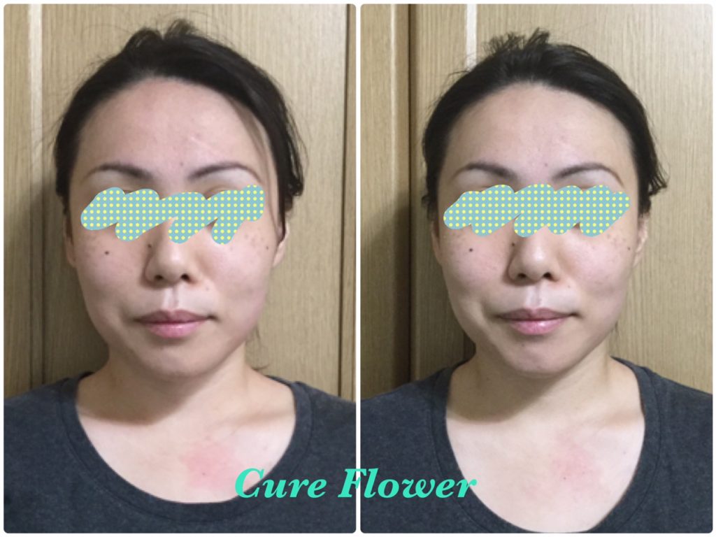 小顔矯正、small face correction