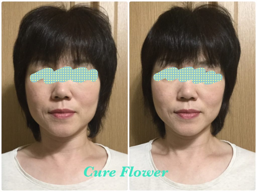 小顔矯正、small face correction