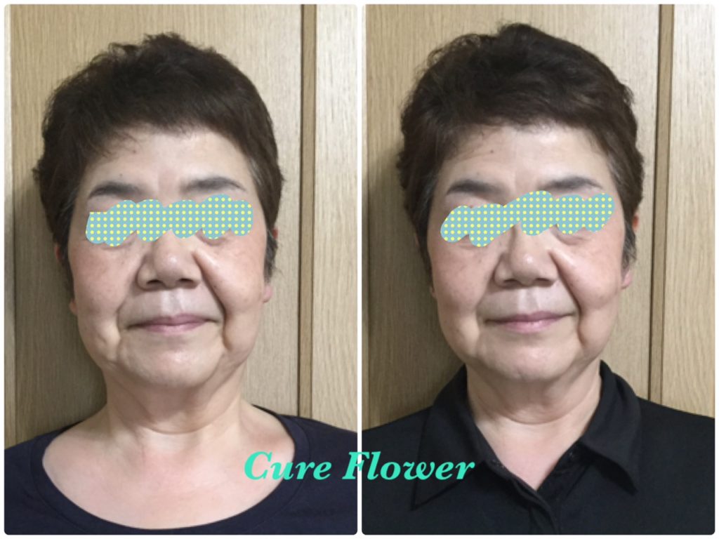 小顔矯正、small face correction