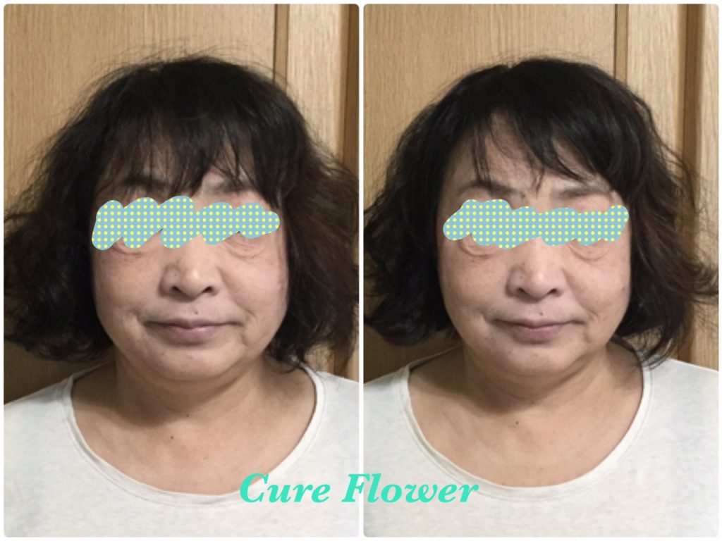 小顔矯正、small face correction