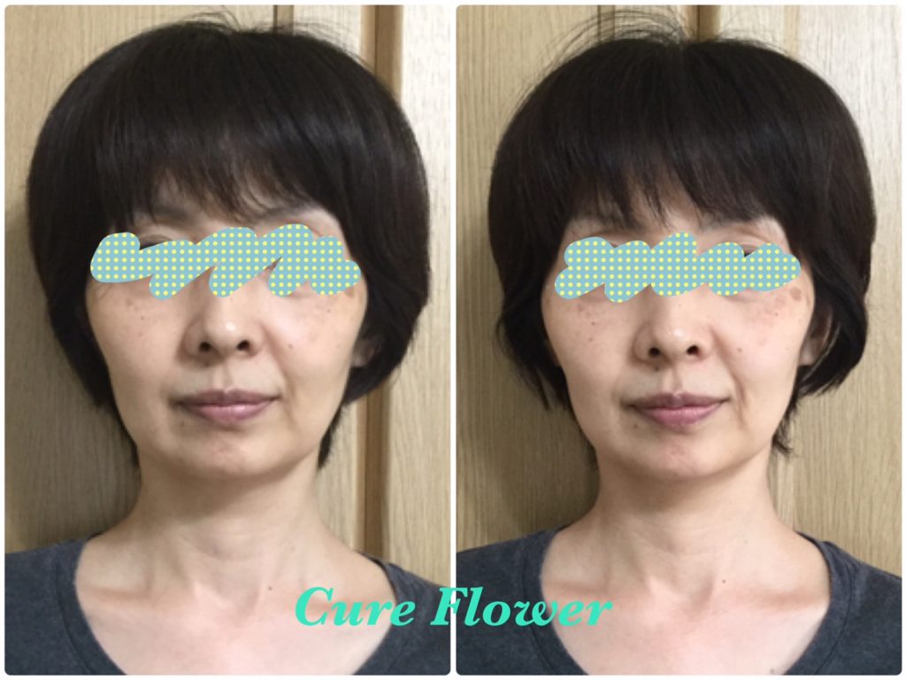 小顔矯正、small face correction