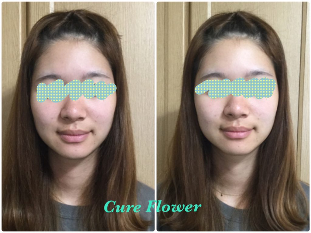 小顔矯正、small face correction