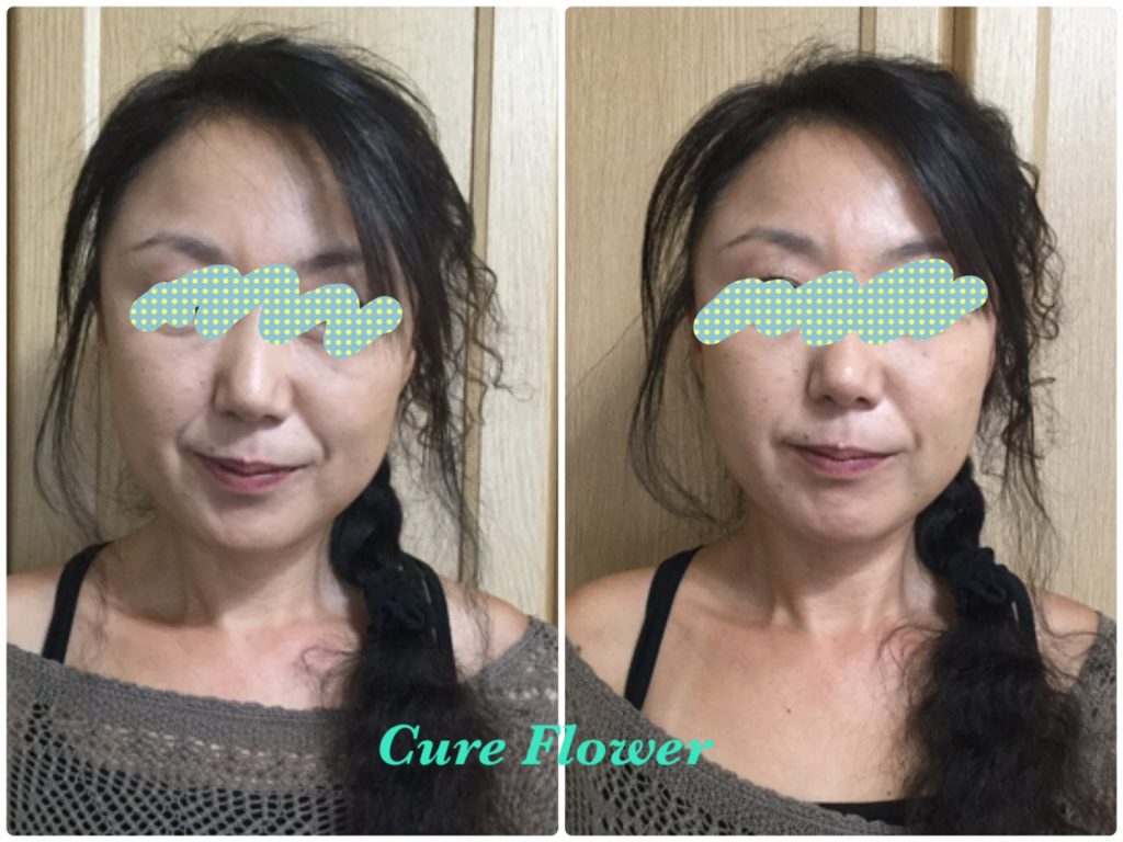 小顔矯正、small face correction