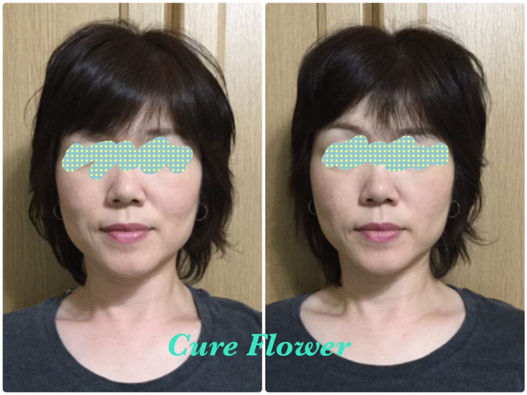 小顔矯正、small face correction