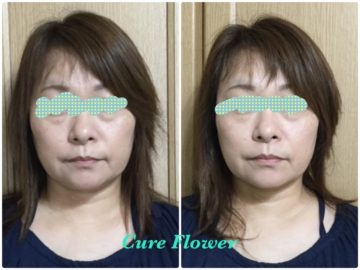 小顔矯正、small face correction