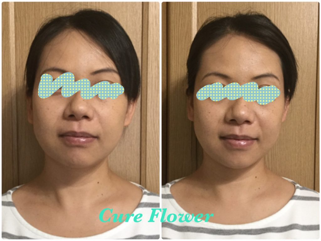 小顔矯正、small face correction