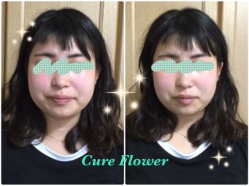 痛くない小顔矯正