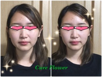 痛くない小顔矯正